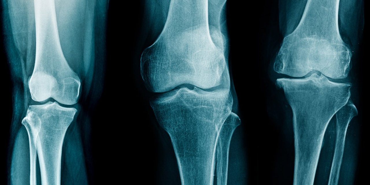 Pansement anti-arthrose : ce qu’il faut savoir