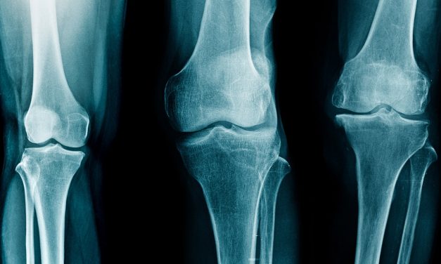 Pansement anti-arthrose : ce qu’il faut savoir